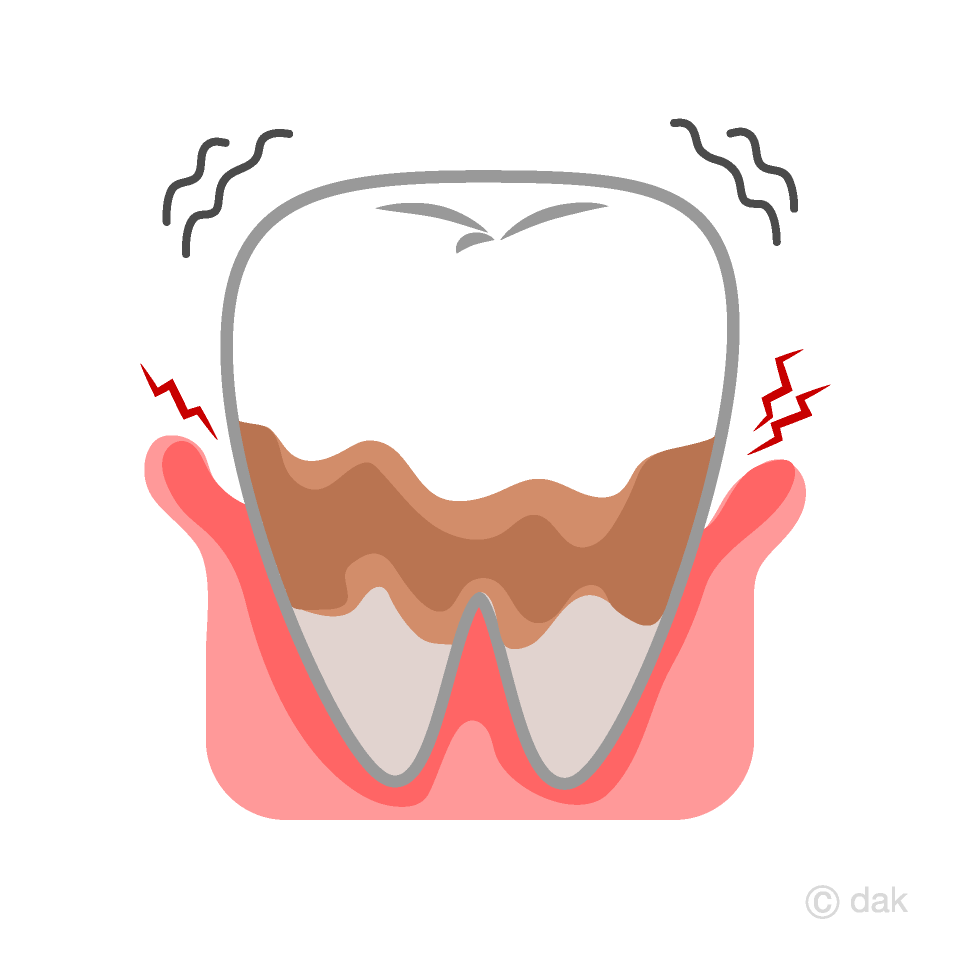 Terrible diente periodontal