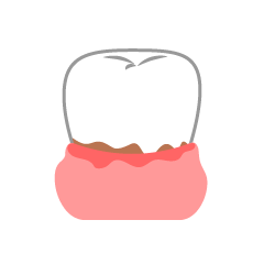 Periodontal Tooth
